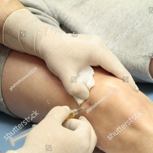 stock-photo-platelet-rich-plasma-prp-used-in-treatment-of-knee-injuries-579153886